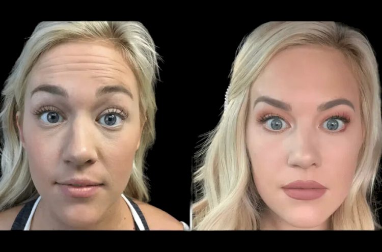 Combining Laser Treatments with Botox in Dubai: What You Need to Know