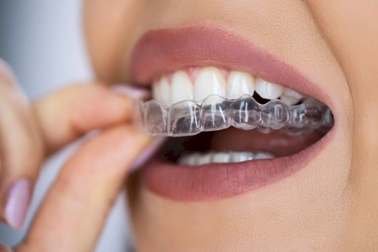 Dental Appliances for TMJ Disorders