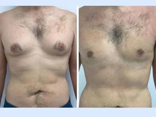 Gynecomastia Surgery in dubai for Health and Aesthetic Goals