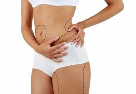 Transform Your Body: Real Liposuction Results from Islamabad Clinics