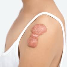 Non-Invasive Solutions for Keloid Scars