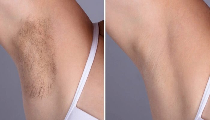 Laser hair removal in Dubai: Benefits for Men and Women